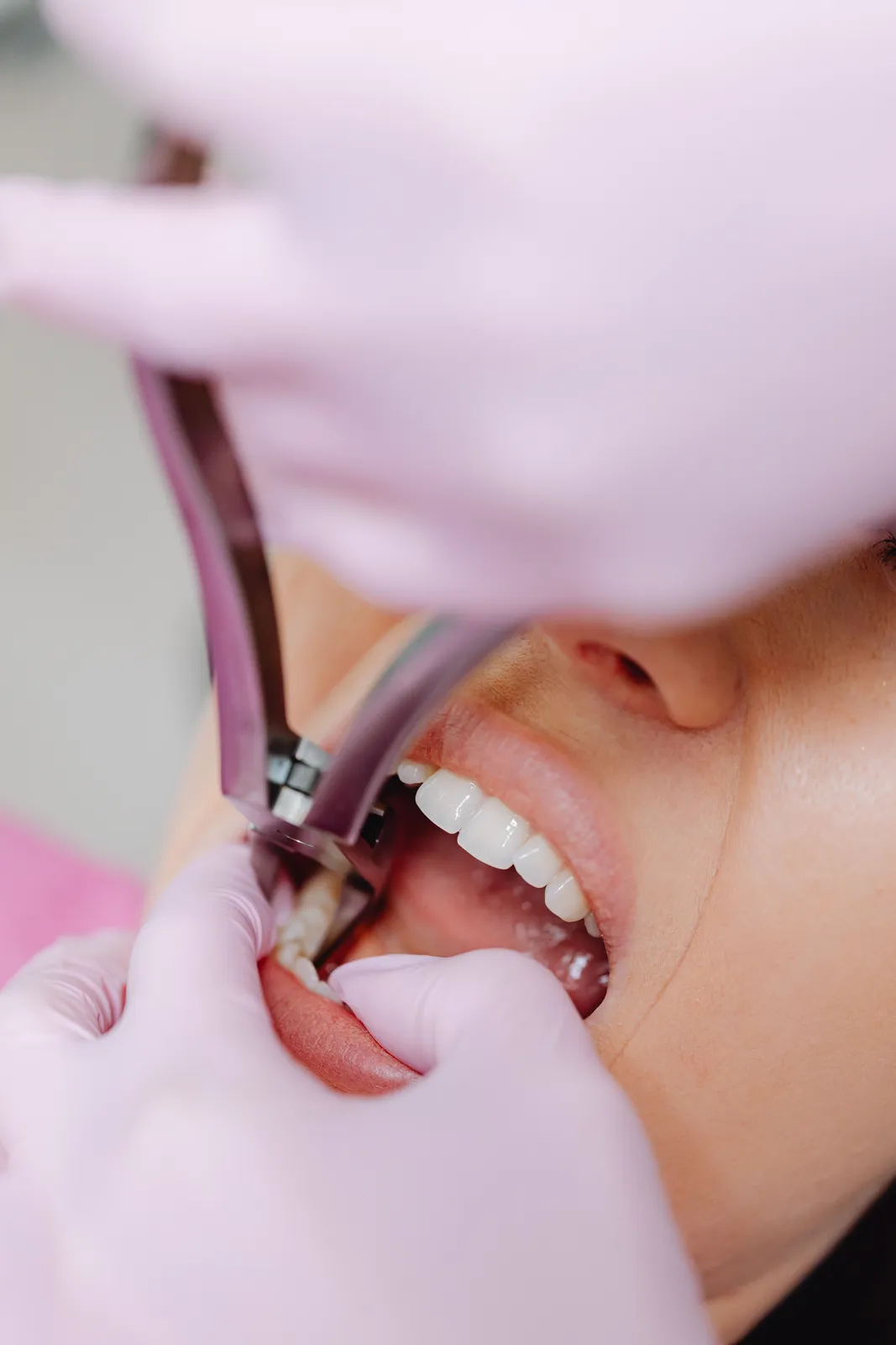 Extraction des dents de sagesse : quand faut-il y penser