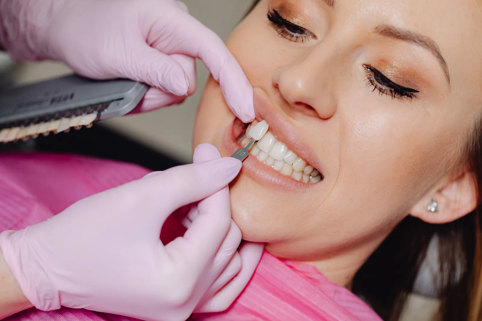 Facettes dentaires : transformer un sourire en douceur