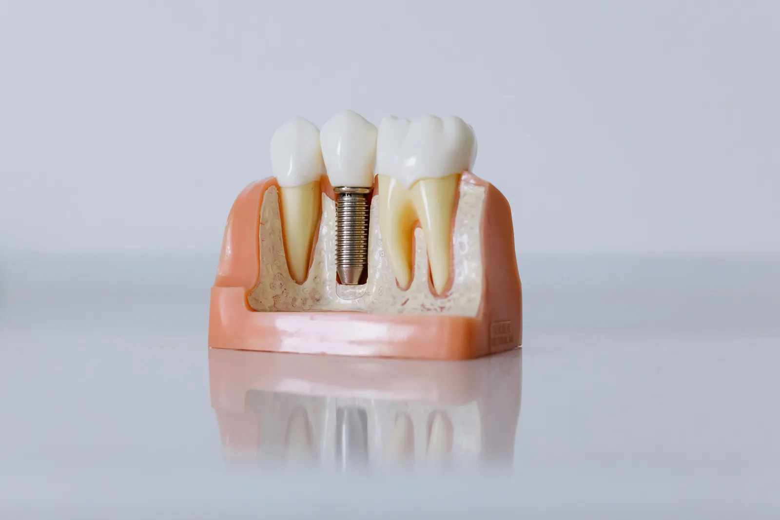 Implantologie : remplacer une dent manquante durablement