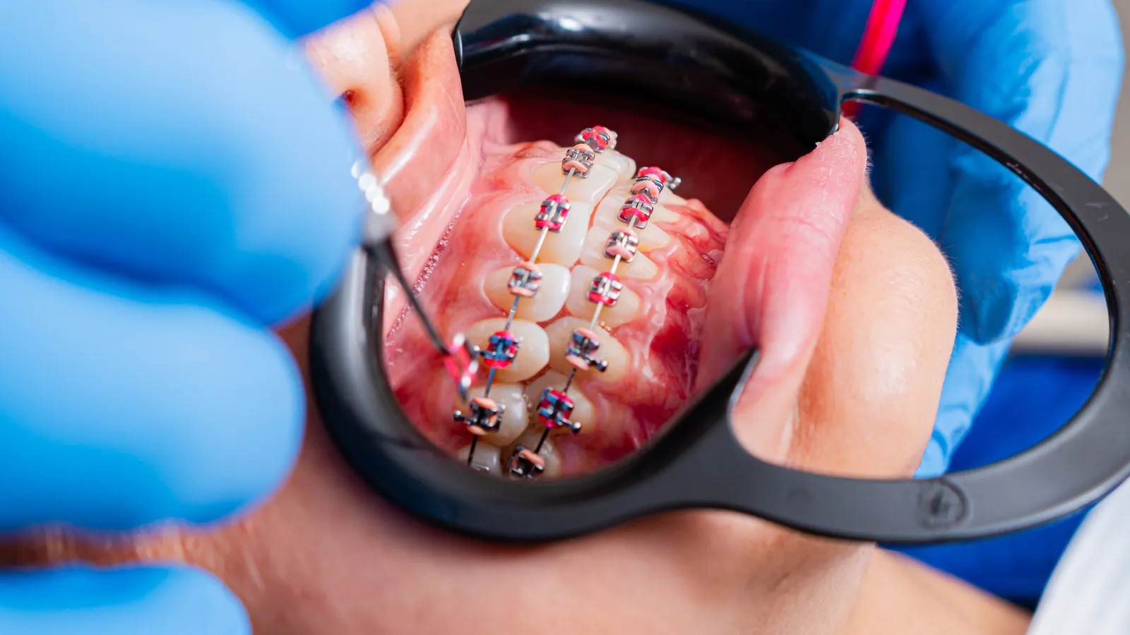 Orthodontie : aligner ses dents à tout âge